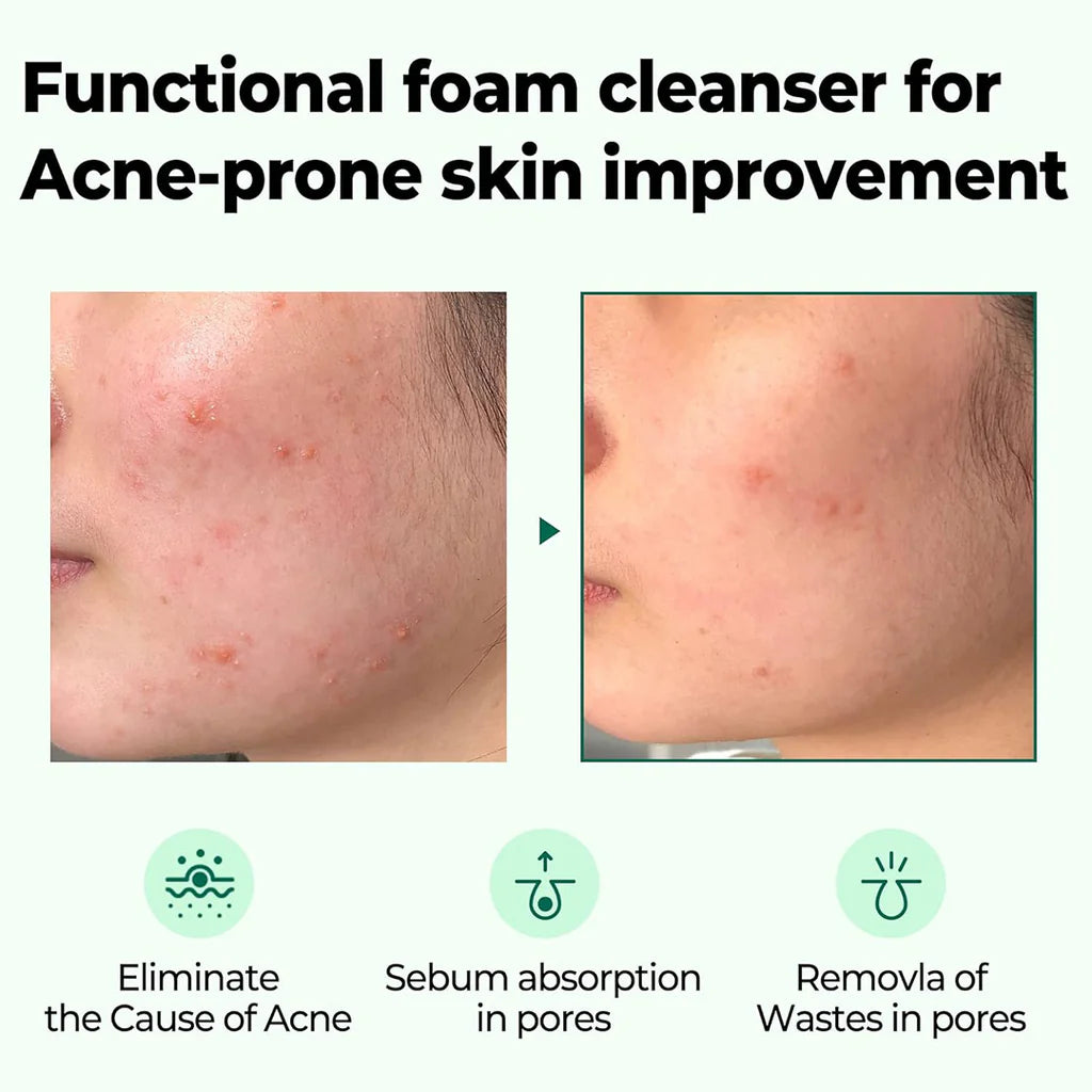 Some By MI AHA.BHA.PHA Miracle Acne Clear Foam